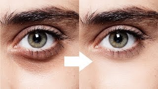 How To Get Rid Of Bags Under Eyes Men | Remove Under Eye Bags | Eye Bags Treatment For Men