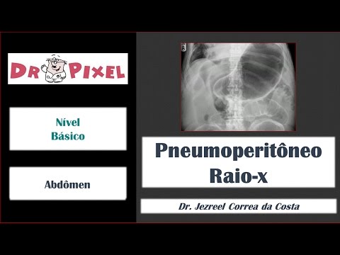 Pneumoperitônio