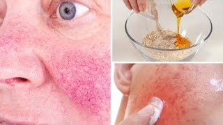 5 Natural Remedies To Get Rid Of Rosacea (Skin Redness)