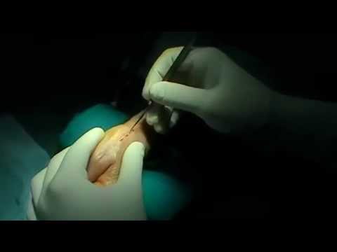 Applicando benda sul gomito Articolazioni rigonfiamento delle mani
