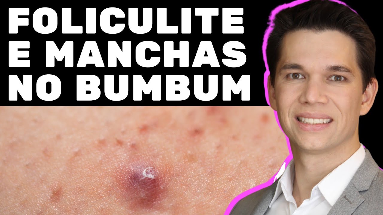 COMO ACABAR COM A FOLICULITE NO BUMBUM