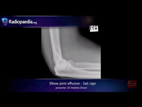 Elbow joint effusion and the sail sign - radiology video tutorial (x-ray)
