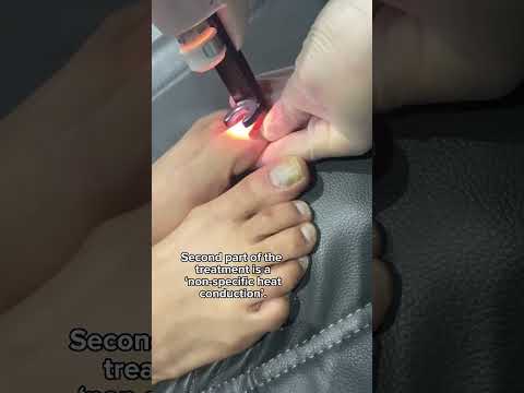 Tratamentul infecției cu ciuperca unghiilor de la picioare