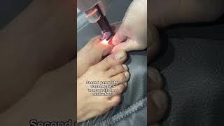 Nail Fungus Laser Treatment at Dr. MediSpa