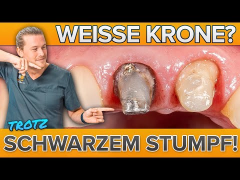 Dunkler Rand am Zahn - Dennoch weisse Krone! Wurzelbehandelter Zahn überkronen! Wieder lächeln!