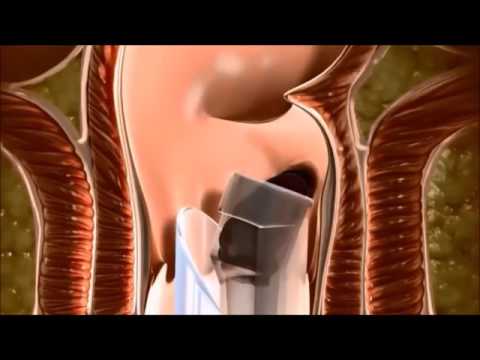 Rubber Band Ligation of Internal Haemorrhoids - Chinese Traditional