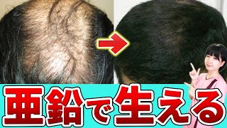 【亜鉛】凄すぎる薄毛予防の効果を発毛のプロが解説