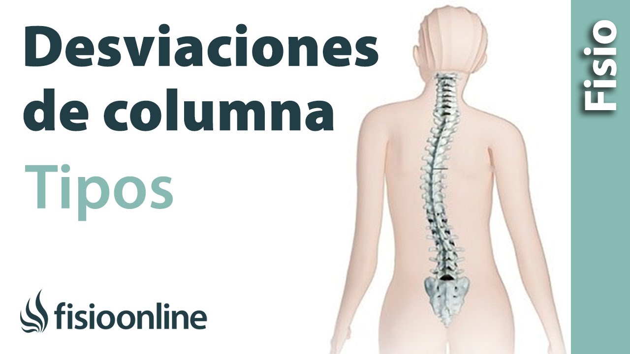 ¿Tipos de desviaciones de la columna.