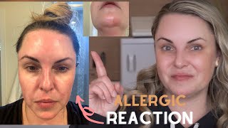 WHAT DID I DO TO MYSELF?? || How to deal w/ an Allergic Reaction & Dermatitis