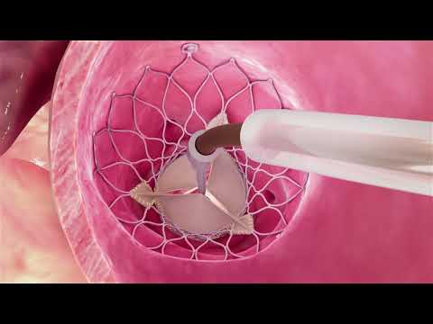 Evolut R Patient Procedural Animation