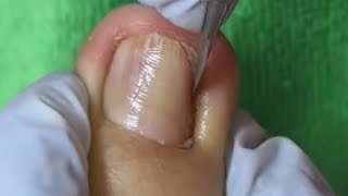 Ep_8925 Foot nails skin removal 👣 พี่จ๋า..มันยังไม่หมด 😅 (clip from Thailand)