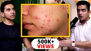 Heal Adult Acne Forever - Accutane, Cortisol & Diet Guidelines By Luke Coutinho