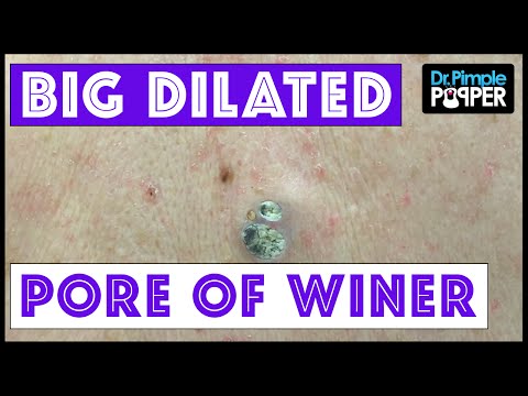 25 Grossest Zit Popping Videos Of All Time - Pimple Popping 2022