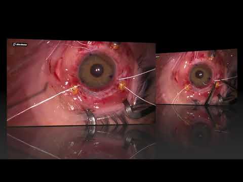 Scleral fixation of the artificial IOL complex Model C