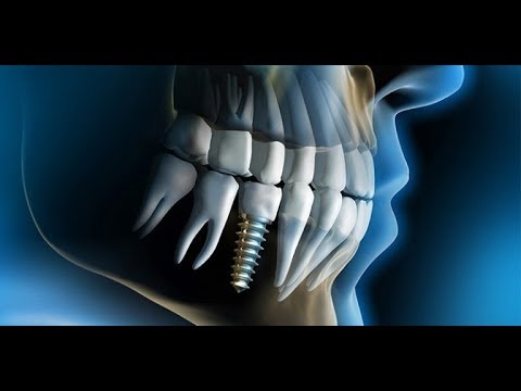 Implante Dentário - Passo a Passo - Cirurgia Completa