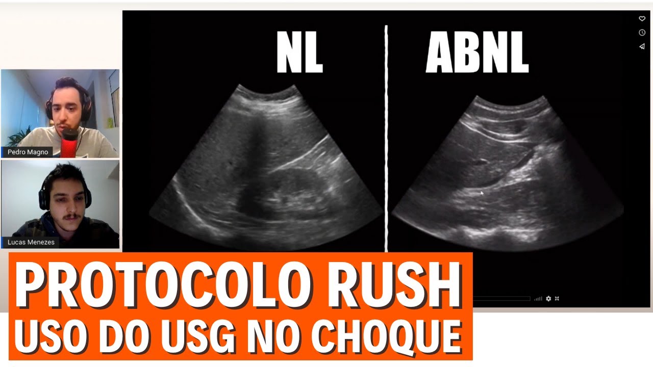 Como diagnosticar a causa do choque usando o USG