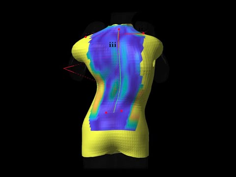 Image - HSS Minute: 3dMD Surface Imaging for Scoliosis Study