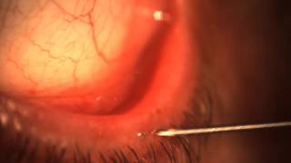 Video removal of double ingrown eyelash! Wait till the end!