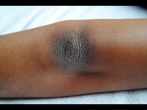 Como tratar el calzado después del hongo de las uñas Como sanar el dedo si arraiga la uña