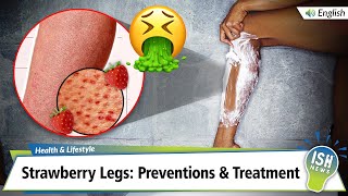 Strawberry Legs: Preventions & Treatment