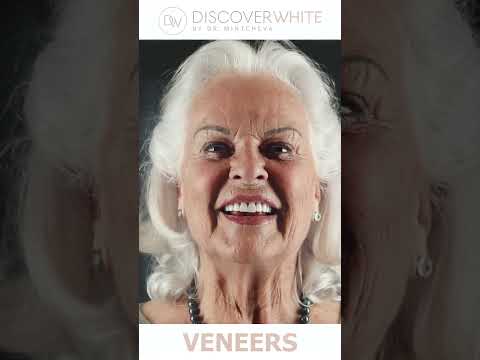 Veneers Vorher Nachher #veneers #zähne #zahnarzt #weißezähne