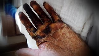 I Lost My Fingers from the Flu