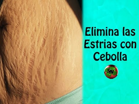 Estrías: qué son, por qué aparecen y un remedio superefectivo para tratarlas