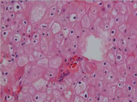 Clear Cell and Chromophobe Renal Cell Carcinoma