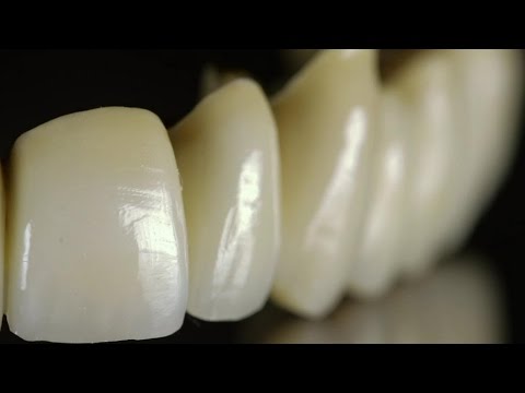 Teleskopbrücke in der Zahnarztpraxis Burbach