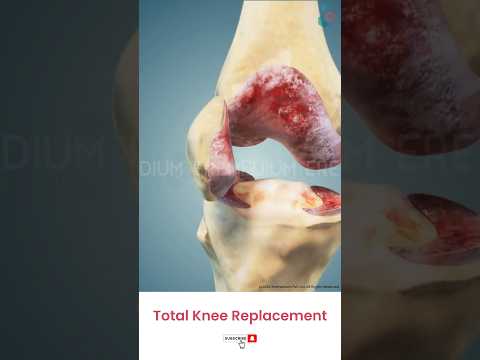 Total Knee Replacement Surgery ↪ 3D Medical Animation #Shorts #KneeReplacement #Knee