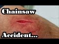 Chainsaw Accident: This Is Why You Wear Chaps!