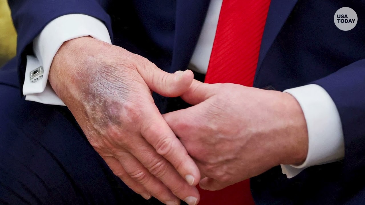 Trump takes more aspirin than recommended by doctors