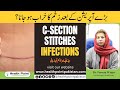 Operation K Bad Zakham Mei Infection C Section Stitch Infections Prevention Dr Fareesa Waqar