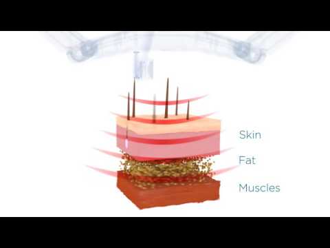 BTL Vanquish ME VIDEO 3D commercial 2016