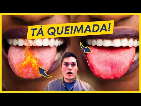 BURNT TONGUE: WHAT TO DO?