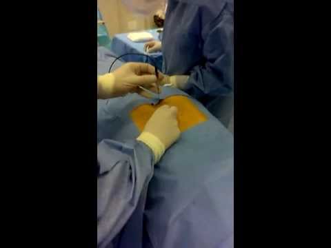 Mal di schiena costante durante le mestruazioni come il Dolorante spalla sinistra dal collo