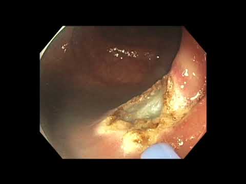 Kolonoskopie: endoskopische Mukosaresektion des Polypen an der Ileozökalklappe