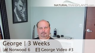 FUT Hair Transplant Followup & Suture Line - Natural Transplants - Orlando, Central Florida (George)
