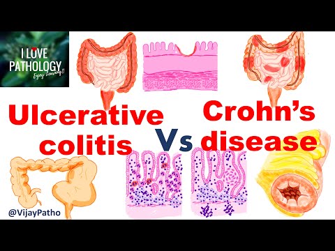 Ulcerative colitis Vs Crohn's disease  #inflammatoryboweldisease
