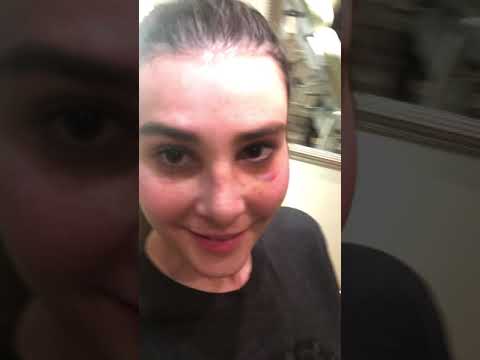 Watch Video: Dr. Rizk shares his patient’s results one week after Rhinoplasty