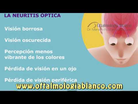Neuritis Óptica