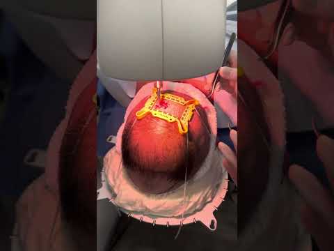 Artas Hair Transplant Video #1