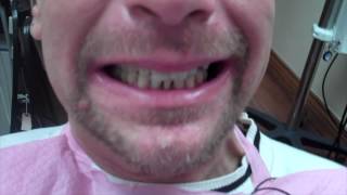 Severly loose teeth saved in 1 day