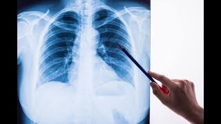 Radiographic Appearance for Pneumocystis Pneumonia