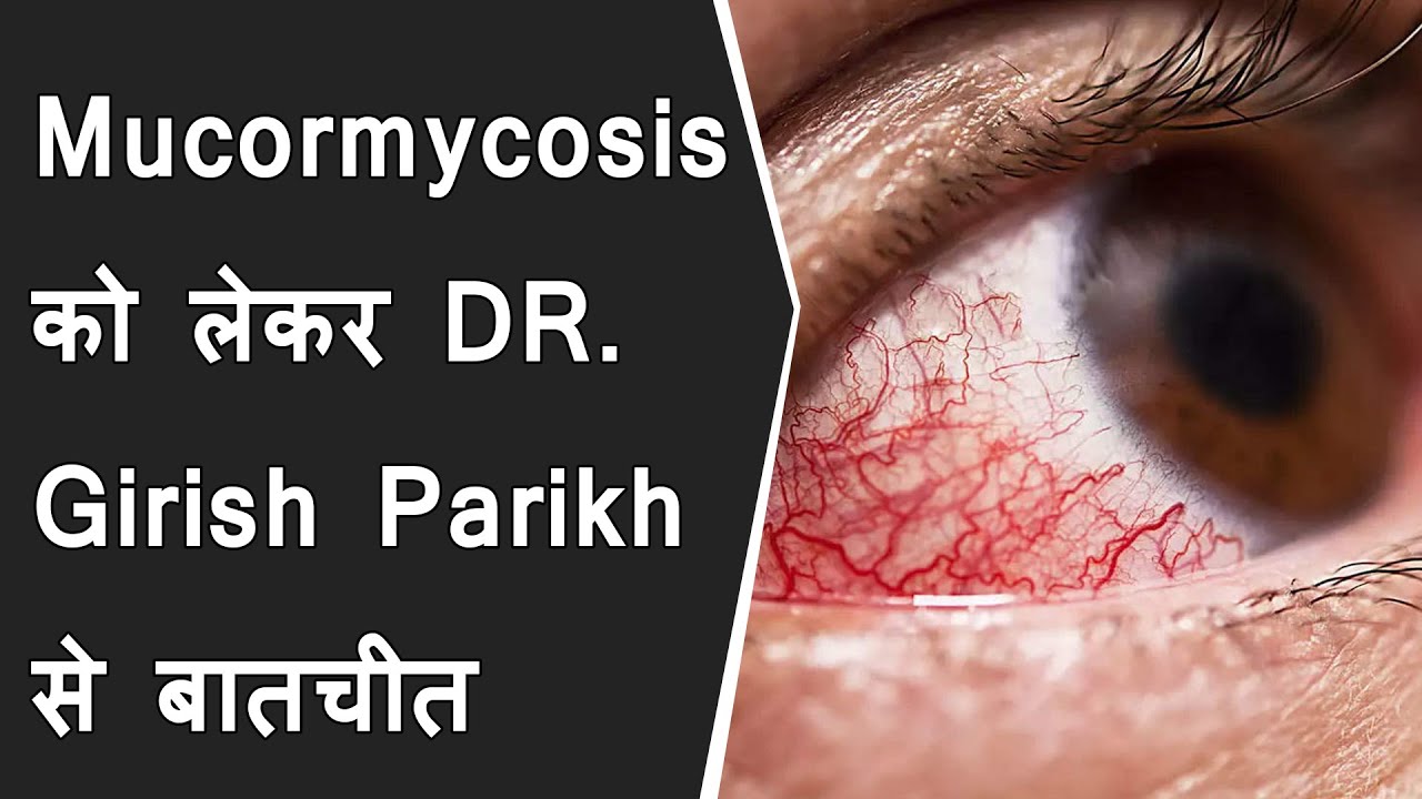 Mucormycosis को लेकर DR. Girish Parikh से खास बातचीत | Things to know about "Mucormycosis"