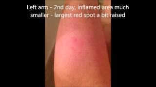 Effect of using sea salt scrub on probable lyme infection in skin