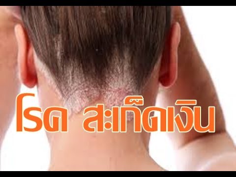 Neurodermatitis ไม่เปียก วิธีการรักษาโรคผิวหนังภูมิแพ้