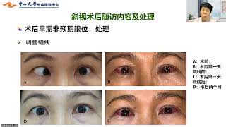 演讲：斜视术后管理