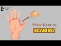 How to cure Scabies? - Dr. Rajdeep Mysore