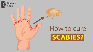 How to cure Scabies? - Dr. Rajdeep Mysore